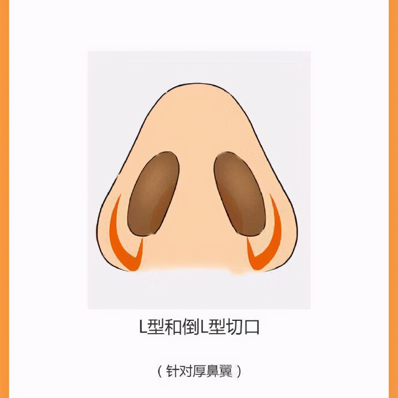 鼻翼缩小的办法(如何选择正确的缩鼻翼方式)-1 鼻翼缩小的办法(如何选择正确的缩鼻翼方式)